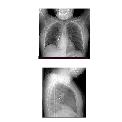 Complesso intervento in urgenza della Chirurgia Toracica del GOM.  Rimosso cacciavit ...