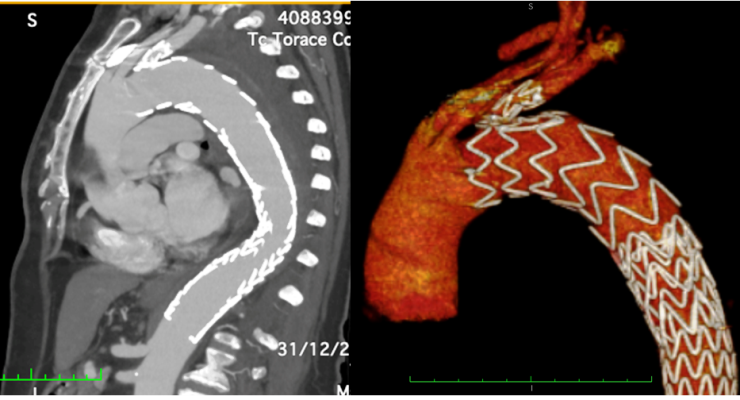 Chirurgia Vascolare del G.O.M.: utilizzato per la prima volta in Calabria un nuovo t ...